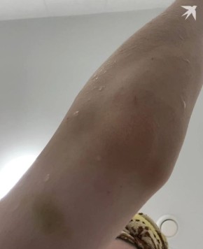 В Екатеринбурге девушка обвинила бывшего парня в побоях