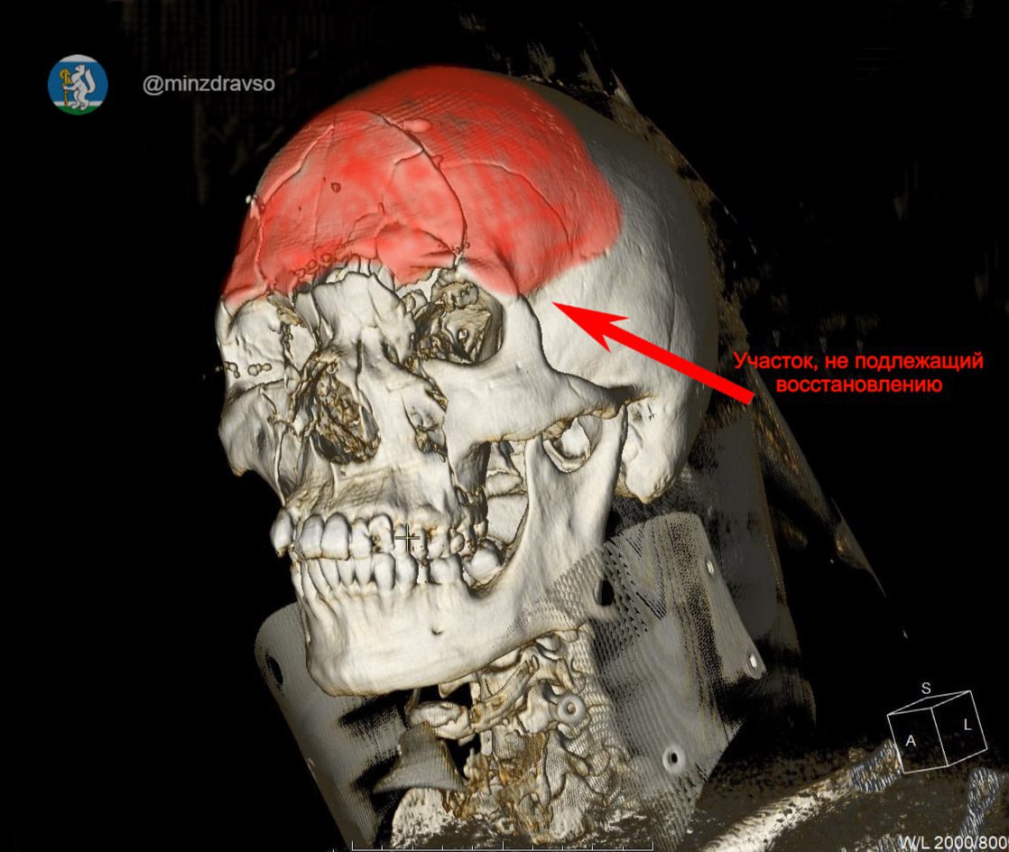 Парня, которому раздробило череп в ДТП, спасли уральские медики Парня, которому раздробило череп в ДТП, спасли уральские медики