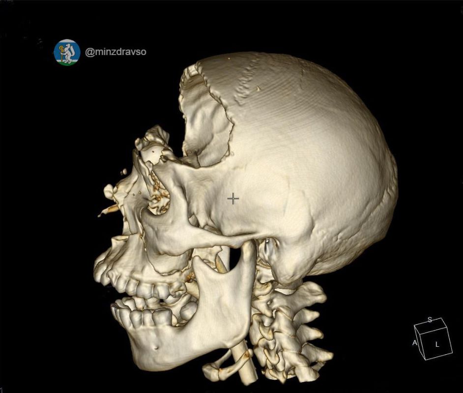 Парня, которому раздробило череп в ДТП, спасли уральские медики