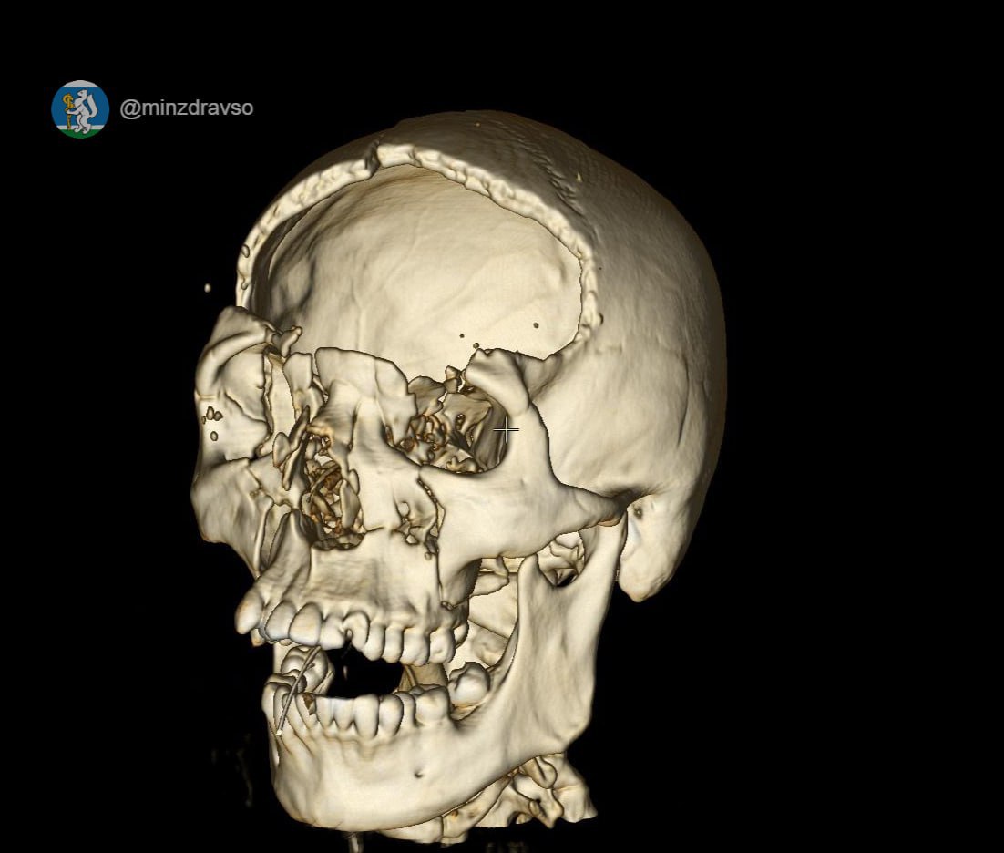 Парня, которому раздробило череп в ДТП, спасли уральские медики Парня, которому раздробило череп в ДТП, спасли уральские медики