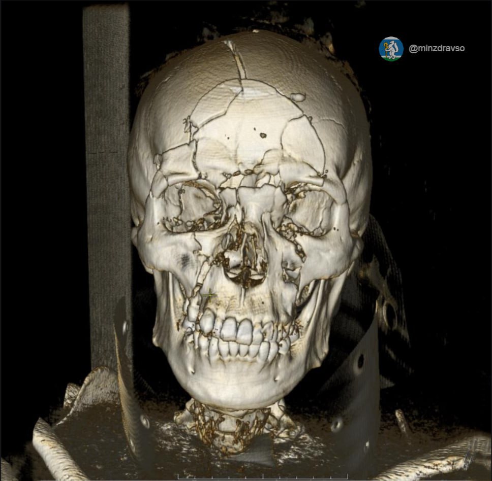 Парня, которому раздробило череп в ДТП, спасли уральские медики Парня, которому раздробило череп в ДТП, спасли уральские медики