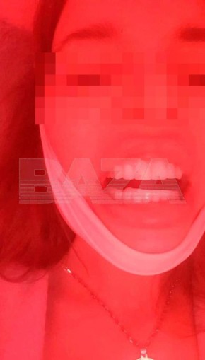 Жительницу Екатеринбурга изуродовали в стоматологии почти за 2 млн рублей