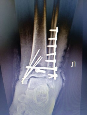1234 Врачи помогли поставить на ноги свердловчанку после падения