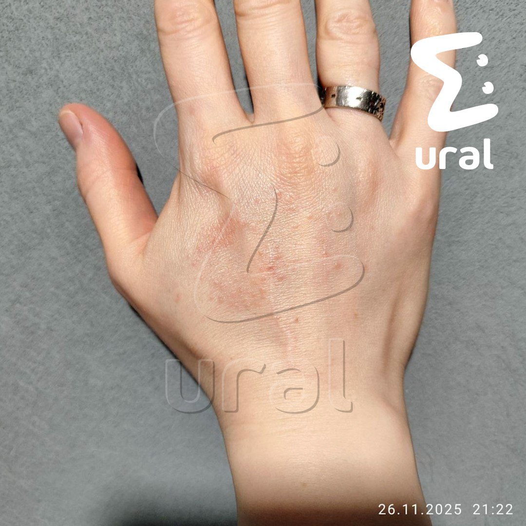 Прыщи от жёлтой воды с песком вылезают у жителей екатеринбургского ЖК "Исеть Парк" Прыщи от жёлтой воды с песком вылезают у жителей екатеринбургского ЖК "Исеть Парк"