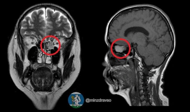 1234Удалить опухоль без единого надреза смогли екатеринбургские онкологи