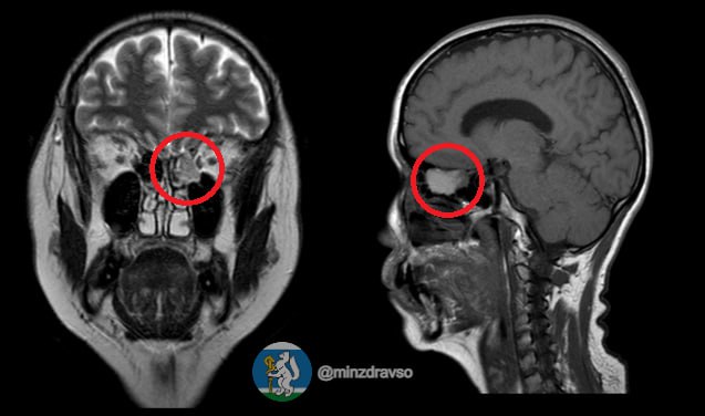 В Свердловской области впервые удалили опухоль черепа через нос