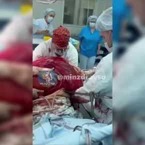 «Вес как у мешка цемента»: уральские онкологи удалили опухоль тяжелее 60 кг