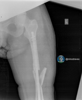 Врачи смогли восстановить сломанную ногу 41-летней беременной свердловчанке, которая упала с 10-метровой высоты