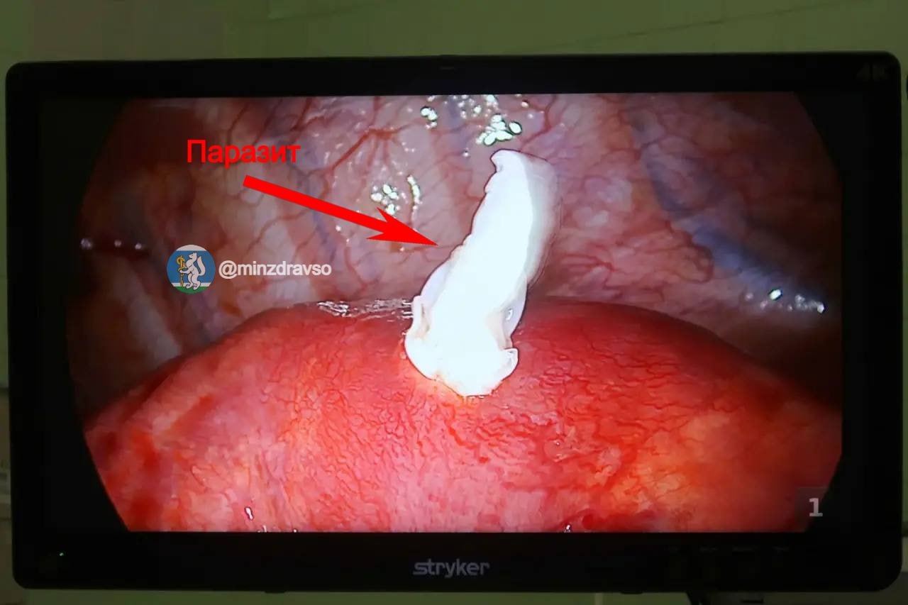 Киста в 11 сантиметров и поражённое лёгкое: уральские хирурги спасли уралочку с редким диагнозом Киста в 11 сантиметров и поражённое лёгкое: уральские хирурги спасли уралочку с редким диагнозом