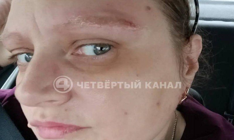 Удаление татуажа обернулось для екатеринбурженки ожогами и долгом в 165 тысяч
