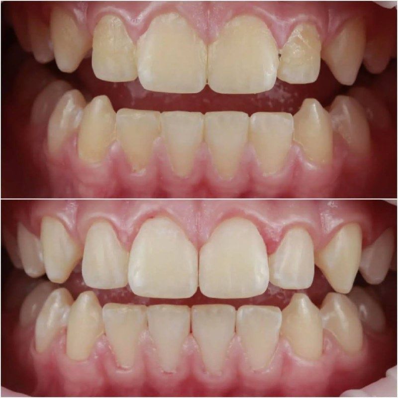 Мягкий зубной налет и его опасности